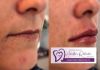 Preenchimento com ácido hialurônico e rejuvenescimento