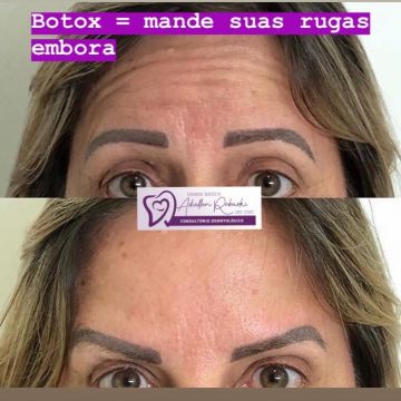 Botox ou preenchimento com ácido hialurônico? Entenda as diferenças