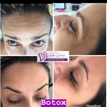 Botox ou preenchimento com ácido hialurônico? Entenda as diferenças