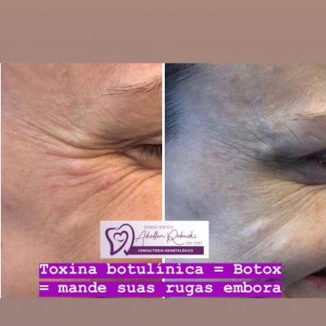 Botox ou preenchimento com ácido hialurônico? Entenda as diferenças