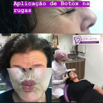 Botox ou preenchimento com ácido hialurônico? Entenda as diferenças