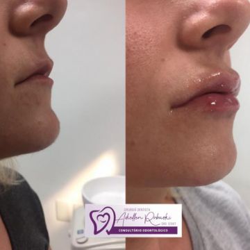 Botox ou preenchimento com ácido hialurônico? Entenda as diferenças