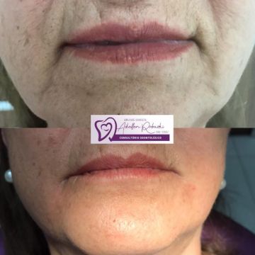 Botox ou preenchimento com ácido hialurônico? Entenda as diferenças