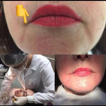 Botox ou preenchimento com ácido hialurônico? Entenda as diferenças