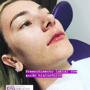 Botox ou preenchimento com ácido hialurônico? Entenda as diferenças