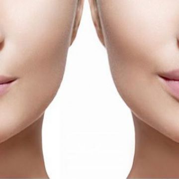 Botox ou preenchimento com ácido hialurônico? Entenda as diferenças
