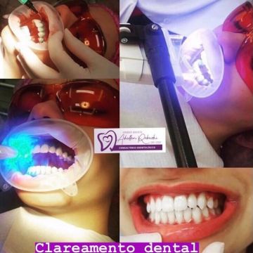 Clareamento dental: o que você precisa saber