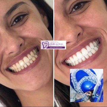 Clareamento dental: o que você precisa saber