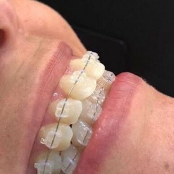 Aparelho ortodôntico: os diferentes modelos e suas funções 