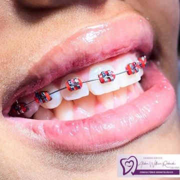 Aparelho ortodôntico: os diferentes modelos e suas funções 