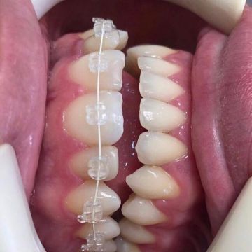 Aparelho ortodôntico: os diferentes modelos e suas funções 