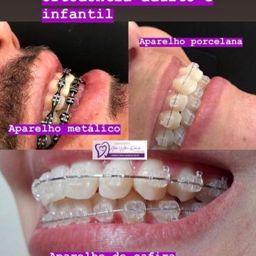 Aparelho ortodôntico: os diferentes modelos e suas funções 