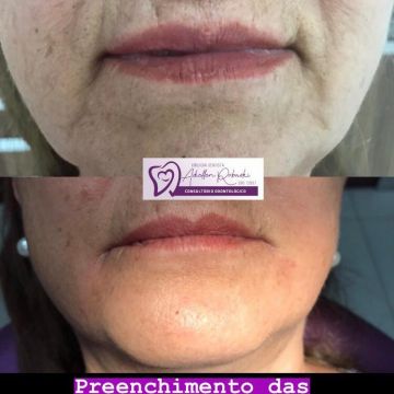 O poder do preenchimento com Ácido Hialurônico para a pele 