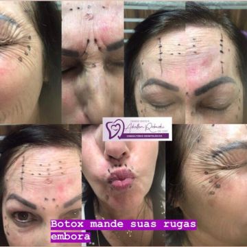 Toxina botulínica como age essa substância e quais os seus benefícios para a pele?