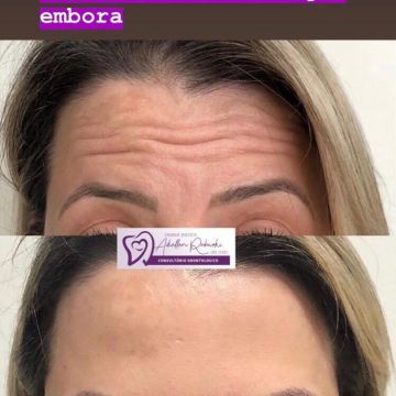 Toxina botulínica como age essa substância e quais os seus benefícios para a pele?