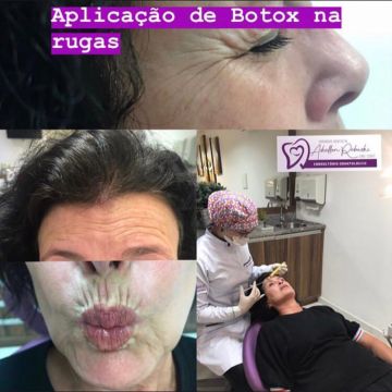 Toxina botulínica como age essa substância e quais os seus benefícios para a pele?