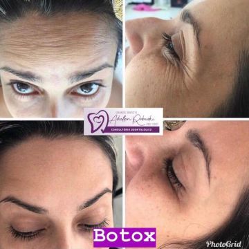 Toxina botulínica como age essa substância e quais os seus benefícios para a pele?