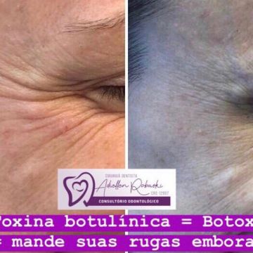 Toxina botulínica como age essa substância e quais os seus benefícios para a pele?