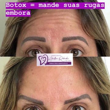 Toxina botulínica como age essa substância e quais os seus benefícios para a pele?