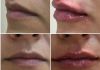 Ácido hialurônico Preenchimento: o que é, para que serve e como usar