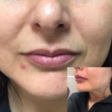 Botox ou preenchimento com ácido hialurônico? Entenda as diferenças