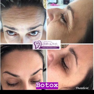 Botox ou preenchimento com ácido hialurônico? Entenda as diferenças