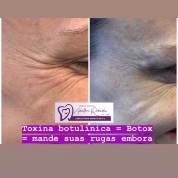 Botox ou preenchimento com ácido hialurônico? Entenda as diferenças