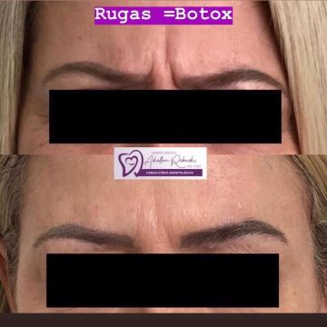Botox ou preenchimento com ácido hialurônico? Entenda as diferenças