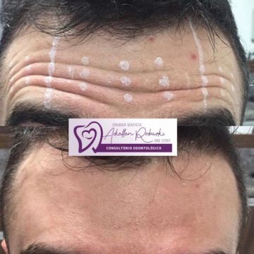 Botox ou preenchimento com ácido hialurônico? Entenda as diferenças