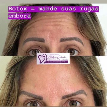 Botox ou preenchimento com ácido hialurônico? Entenda as diferenças