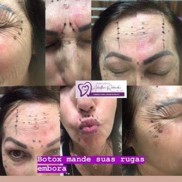 Botox ou preenchimento com ácido hialurônico? Entenda as diferenças