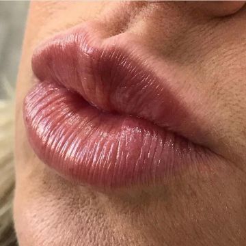 Botox ou preenchimento com ácido hialurônico? Entenda as diferenças