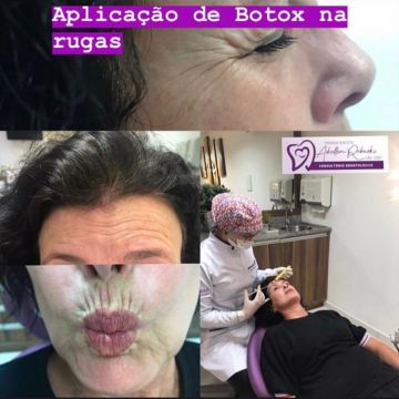 Botox ou preenchimento com ácido hialurônico? Entenda as diferenças