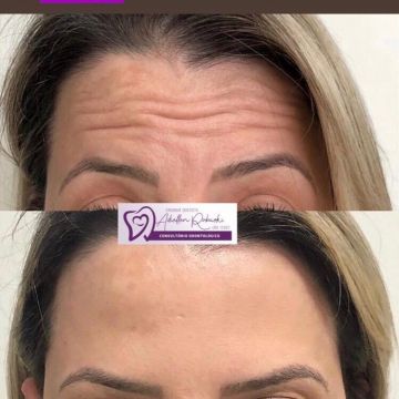Botox ou preenchimento com ácido hialurônico? Entenda as diferenças